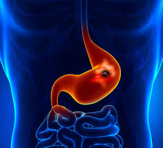 Cáncer Gástrico 2